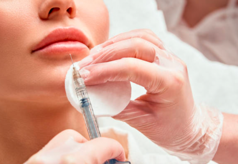 Aplicação de Botox na Boca Valor Centro - Aplicação de Botox nos Lábios