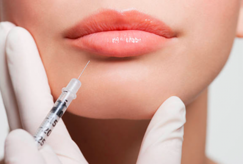 Aplicação de Botox nos Lábios Cinco - Aplicação Botox Testa